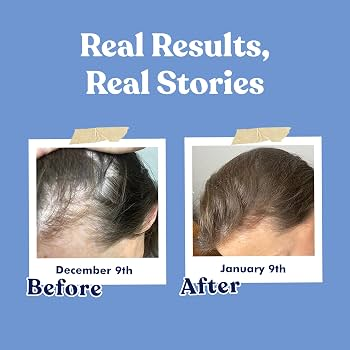 For Hair Growth - Anti Hairfall - Supports your Hair Growth - Biotin Plus Zinc (Supports your&nbsp;hair, nails, and overall nutritional needs) – 2500 mcg Biotin, 30 Tablets