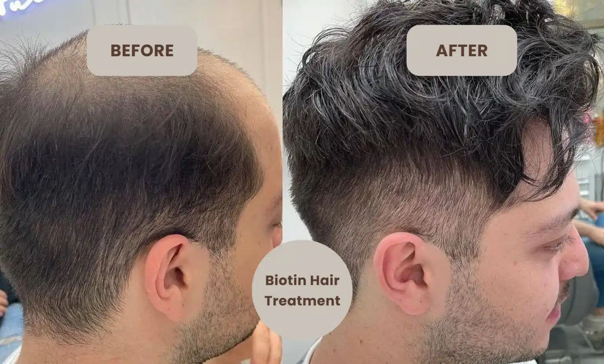 For Hair Growth - Anti Hairfall - Supports your Hair Growth - Biotin Plus Zinc (Supports your&nbsp;hair, nails, and overall nutritional needs) – 2500 mcg Biotin, 30 Tablets