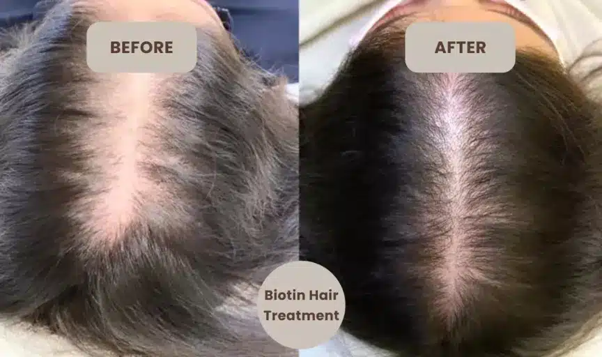 For Hair Growth - Anti Hairfall - Supports your Hair Growth - Biotin Plus Zinc (Supports your&nbsp;hair, nails, and overall nutritional needs) – 2500 mcg Biotin, 30 Tablets
