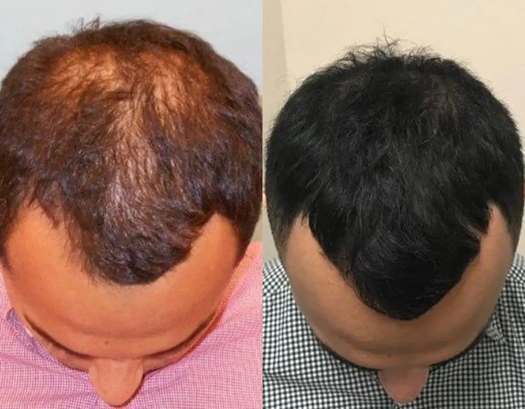 For Hair Growth - Anti Hairfall - Supports your Hair Growth - Biotin Plus Zinc (Supports your&nbsp;hair, nails, and overall nutritional needs) – 2500 mcg Biotin, 30 Tablets